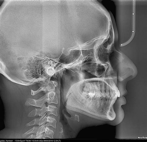 Lateral Ceph - Radiodent | Dental And Maxillofacial Imaging