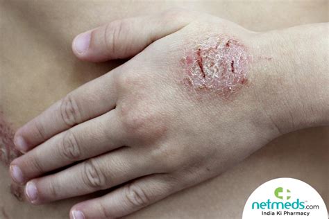 Dyshidrotic Eczema (Dyshidrosis): Symptoms, Causes, Treatments | vlr.eng.br