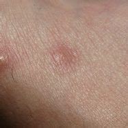 Hobo Spider Bite Treatment - Spider Bite Treatment