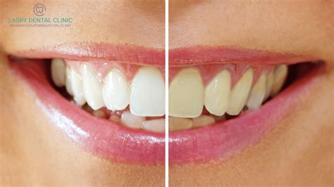 Teeth Bleaching By Dentist & Why It’s Better Than At-Home Products