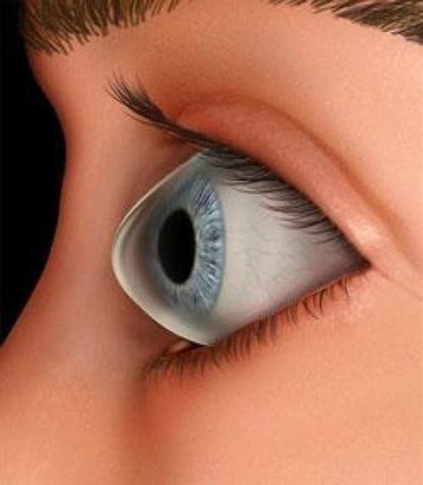 40 best images about Keratoconus on Pinterest | Bingo, College of and Ghost images