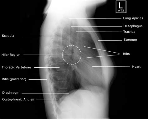 Chest Radiographic Anatomy - wikiRadiography