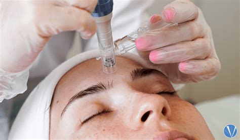 Does Microneedling Work? | Vujevich Dermatology Associates