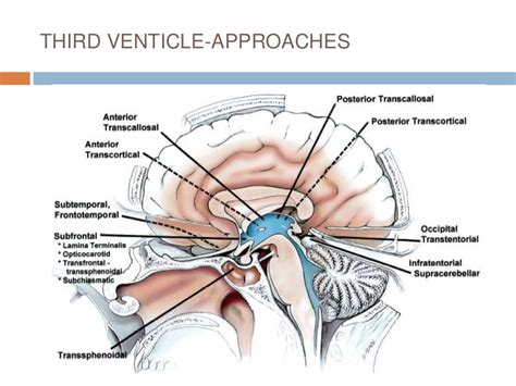 Third ventricle surgical anatomy and approaches