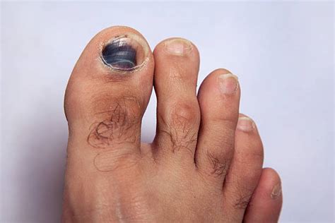 Broken Toe Nail Stock Photos, Pictures & Royalty-Free Images - iStock