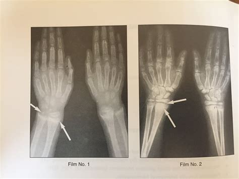 XRAYS OF RICKETS DISEASE