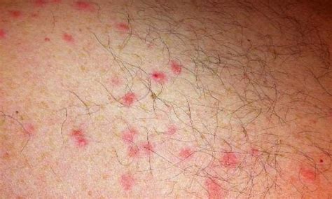 What Does Scabies Look Like