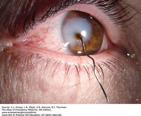 Traumatic Iritis Slit Lamp