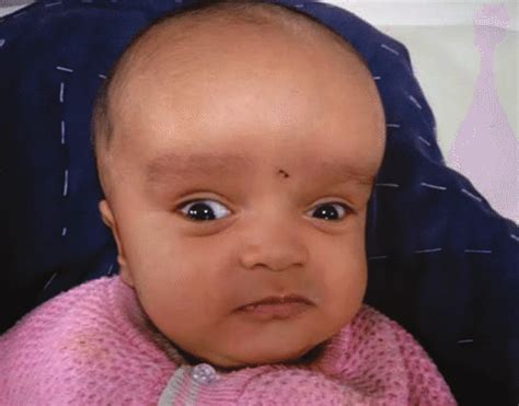 What is Macrocephaly? - MBBCH Health Encyclopedia