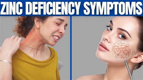 12 ZINC DEFICIENCY SYMPTOMS You Should Know!