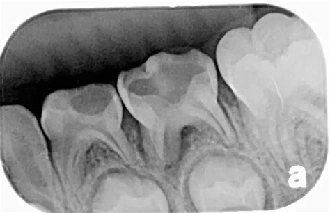 What is a dental abscess?