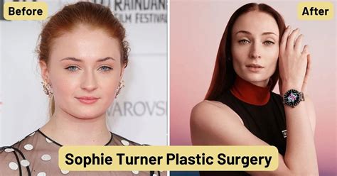 Did Sophie Turner Get Plastic Surgery? The Inside Scoop! - Venture jolt