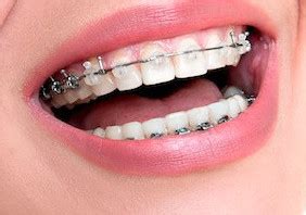 best-dental-floss-for-braces-1 | ORAL HEALTH SOLUTIONS