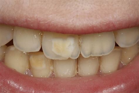 Brown Stains On Teeth – 3 Causes and The Best Solution