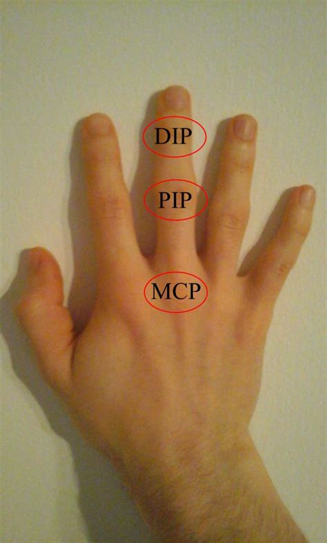 Metacarpophalangeal dislocation (finger) - WikEM