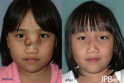 Craniofacial - Before & Afters - James P Bradley, MD