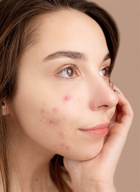 The Truth About Acne - The Dermatology Clinic