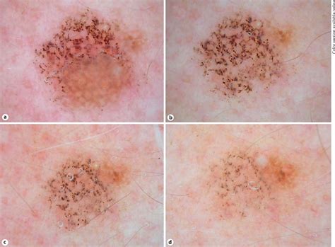 Different Types Of Keratosis Skin Lesions