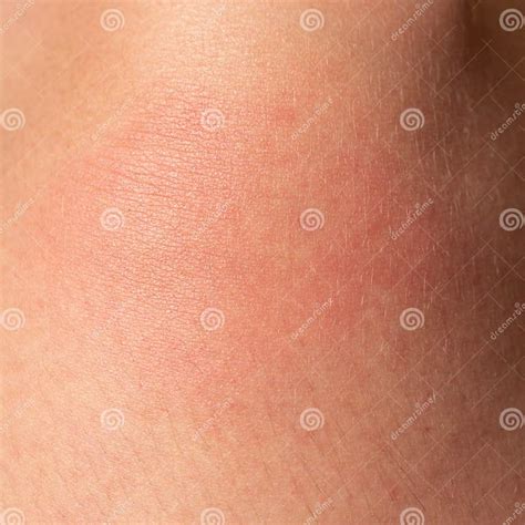 Allergy on the Human Body and Redness from a Wasp Sting. Stock Photo ...