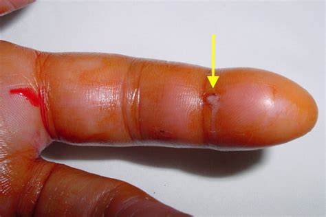 Hand Infections - Dr. Jonathan Lee Yi-Liang