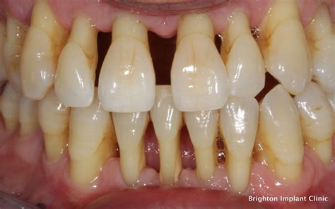 What is perio? | Halesowen Dental
