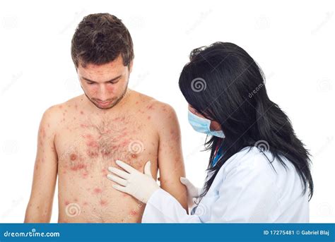 Skin Rash And Blisters On Body. Shingles On Men Herpes Zoster Royalty-Free Stock Image ...