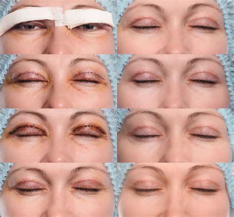 Blepharoplasty of the Upper Eyelid. Stock Image - Image of close, care ...