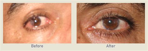 Pterygium Removal | Before & After Photo Gallery | Los Angeles