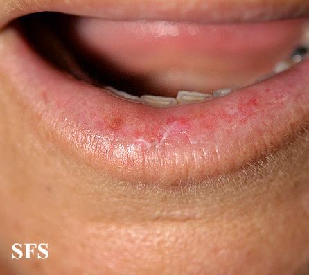 Lichen Planus (Skin, Mouth) Causes, Pictures and Treatment | Healthhype.com