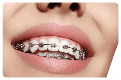 Metallic Braces - Elyzee Day Surgery Medical Center L.L.C