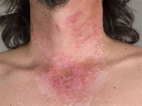 lupus skin rash pictures - pictures, photos