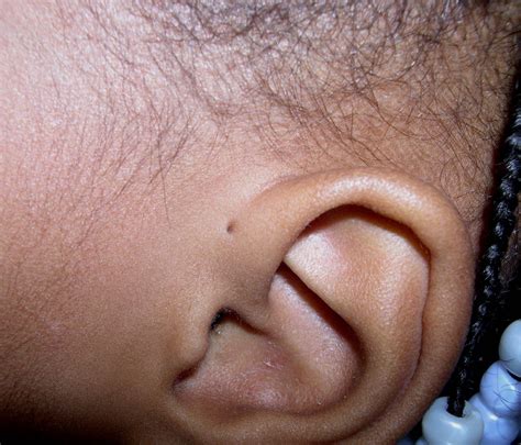 Preauricular Pits: A Hole in Your Child's Ear