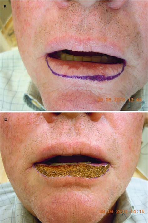 Basal Cell Carcinoma Lip