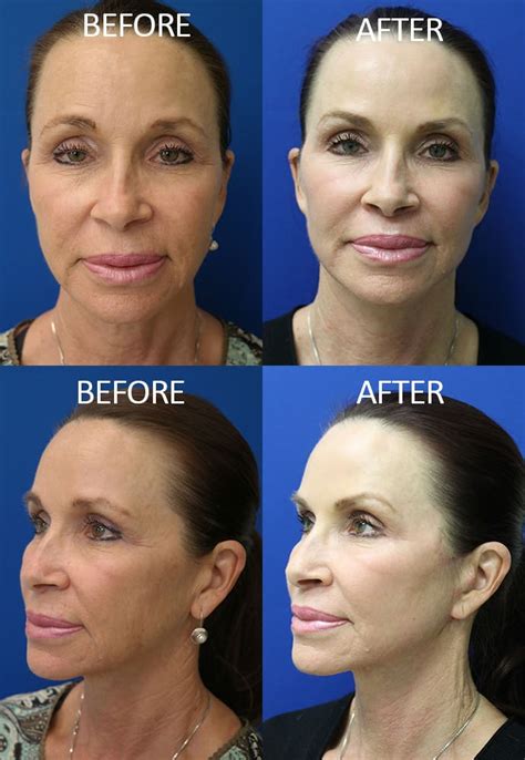 Fractionated CO2 Laser Skin Resurfacing in McLean, VA