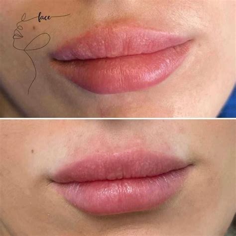 5 Effective Alternatives to Lip Fillers in 2023