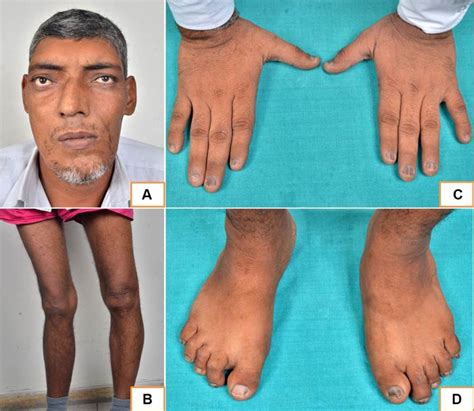 Albums 97+ Pictures Pictures Of Acromegaly And Gigantism Latest