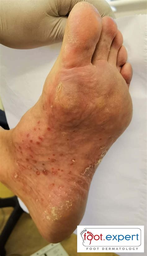 Palmoplantar Pustulosis or Psoriasis?