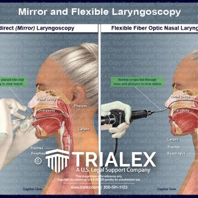 Mirror and Flexible Laryngoscopy - TrialExhibits Inc.