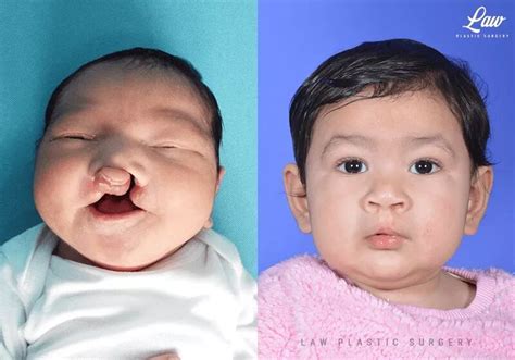 Bilateral Cleft Lip And Palate Before And After