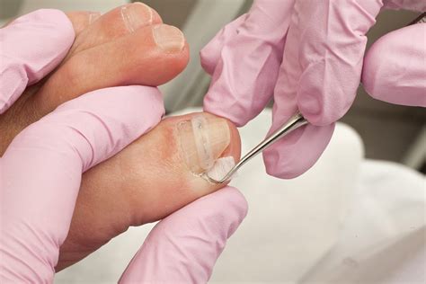 Ingrown Nails | Dr Joycelim Dermatologist & Skin Specialist