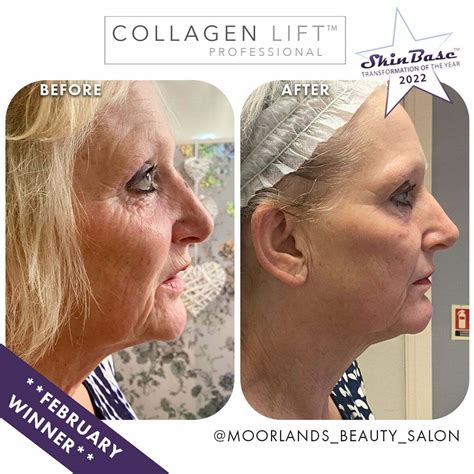 Collagen Lift Before and After Images