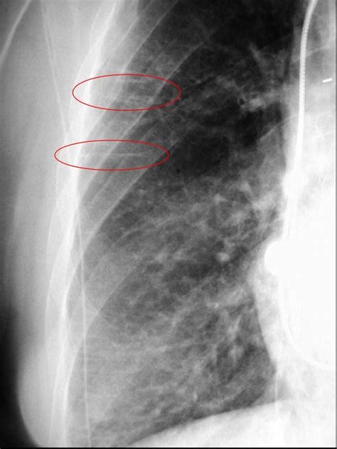 4.13 - Kerley B Lines - caused by fluid in (usually) or thickening of ...