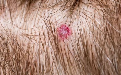 Scalp Folliculitis: Causes, Symptoms & Ayurvedic Remedies – Vedix