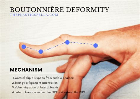 Swan Neck Deformity vs Boutonnières