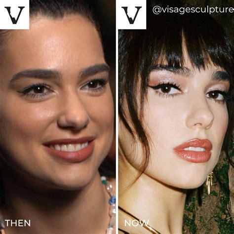 Singer Dua Lipa looks amazing then and now. A subtle nose job can just ...