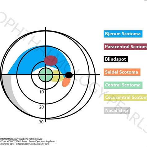 Pin by Jim Payne on Oftalmologia | Optometry education, Eye health ...