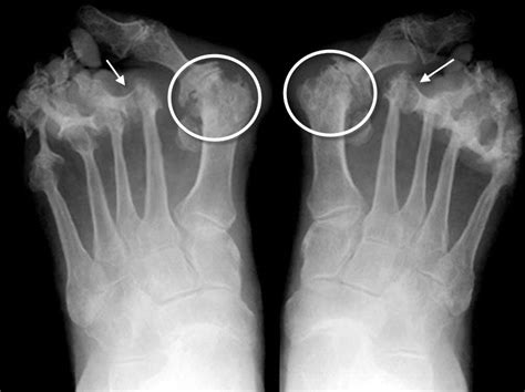 Rheumatoid Arthritis X Ray Foot