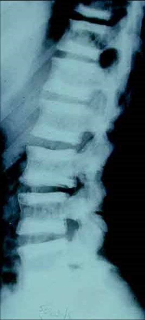 Osteopetrosis - Pediatrics - Orthobullets