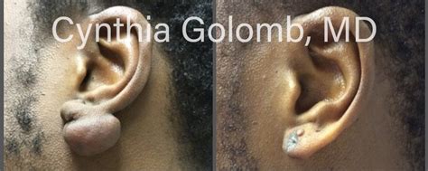 Treating keloids on ear lobes – Cynthia Golomb, MD | Dermatology Boutique