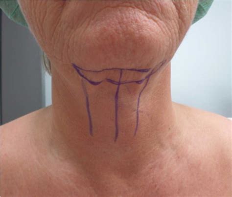 Submental Neck Lift: Preoperative markings of the elliptical skin... | Download Scientific Diagram